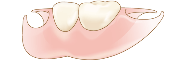 バネのない部分入れ歯イメージ