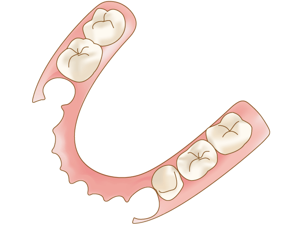 バネのない奥歯の部分入れ歯イメージ
