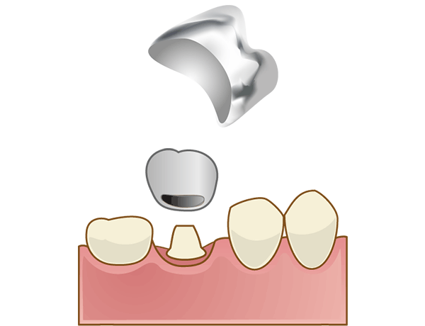 保険診療の被せ物（銀歯）イメージ