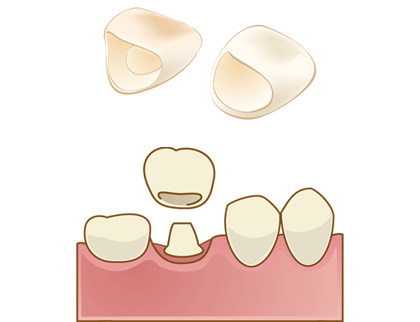 自費診療の被せ物（セラミック）イメージ