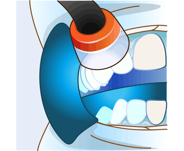 オフィスホワイトニングの施術イメージ