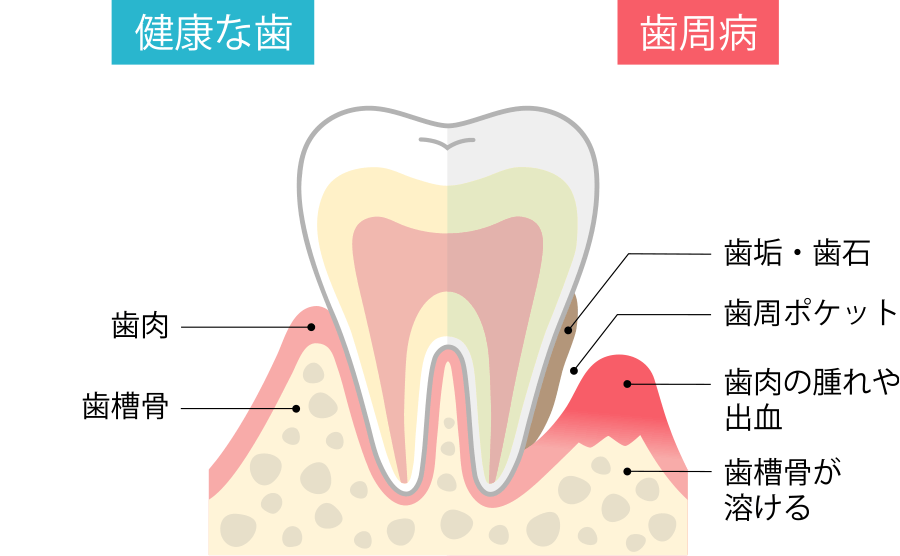 歯周病の仕組み
