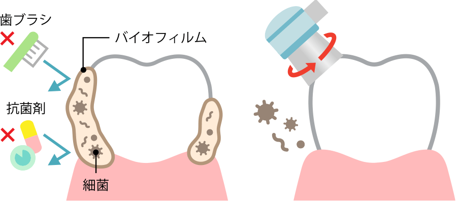 歯周病は予防と定期的なメンテナンスがポイントです