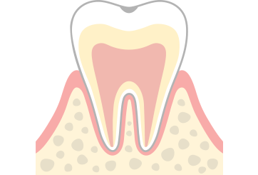 C0 虫歯のはじまり