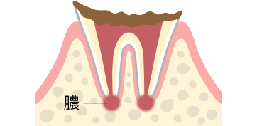 C4　歯根まで達した虫歯